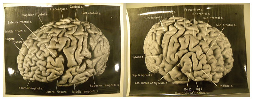 "Einstein's brain," photos by Thomas Harvey, 1955.